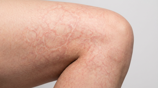 Marmorierte Haut mit netzartigem Muster auf dem Oberschenkel nach Hitzeeinwirkung.